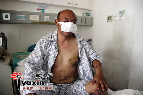 新疆沙灣村民山中撿玉遭棕熊攻擊 鼻子、上嘴唇被咬掉撿回一命（圖）