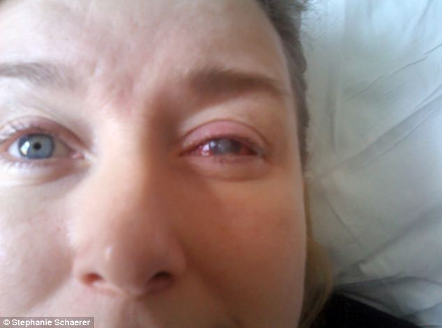 恐怖慎入！隱形眼鏡致英女子摘除眼球