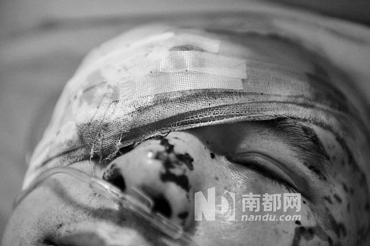 李建新頭部還有被潑硫酸的痕跡，醫(yī)生說(shuō)被砍傷的右眼已經(jīng)失明。 南都記者 田飛 攝