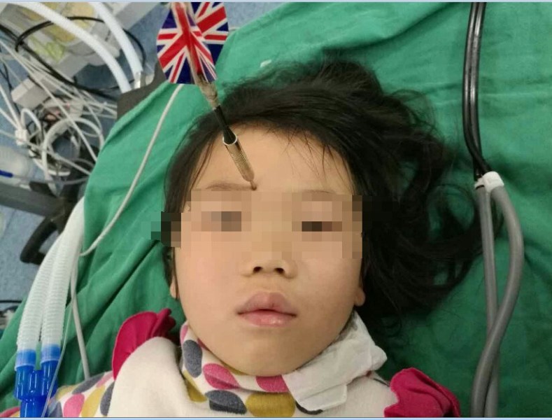 十多公分長(zhǎng)的飛鏢穩(wěn)穩(wěn)地 ” 定 ” 在了一名六歲半的女童額頭上，小青一家人凌晨從長(zhǎng)順趕到貴醫(yī)附院急診室時(shí)，看到如此慘烈的情況，接診醫(yī)生都嚇了一跳。詳細(xì)詢(xún)問(wèn)下得知，原來(lái)是七歲的哥哥和六歲半的表妹在玩耍時(shí)，哥哥不慎將路邊撿來(lái)的真飛鏢扎到了妹妹的額頭上。