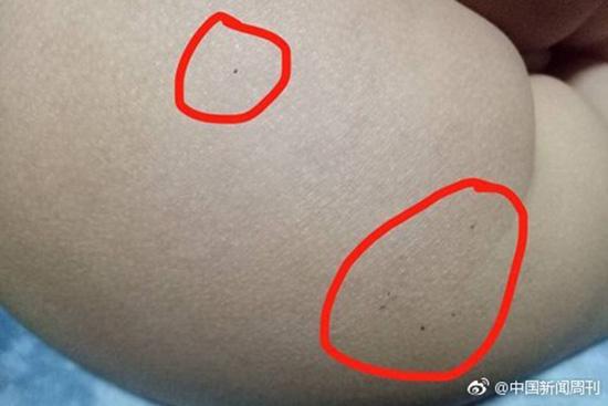 據(jù)多名紅黃藍(新天地分園)家長反映，孩子腿部、屁股、腋下出現(xiàn)針眼。