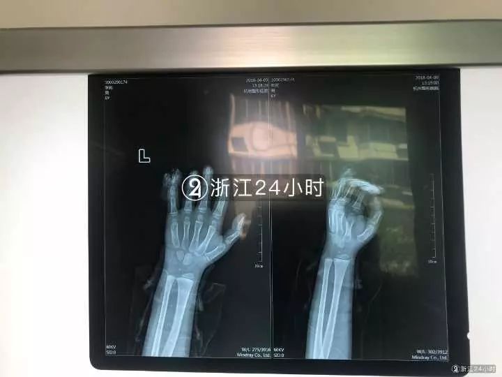 嚇哭！6歲男孩被夾斷手指 罪魁禍?zhǔn)拙故切７? oldsrc=