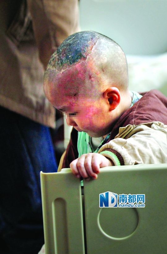 1月8日下午，小寶頭上和臉上都是傷痕。