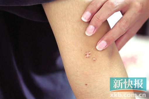 取出針后李星兒手臂留下了傷口。新快報(bào)記者 張國鋒/攝