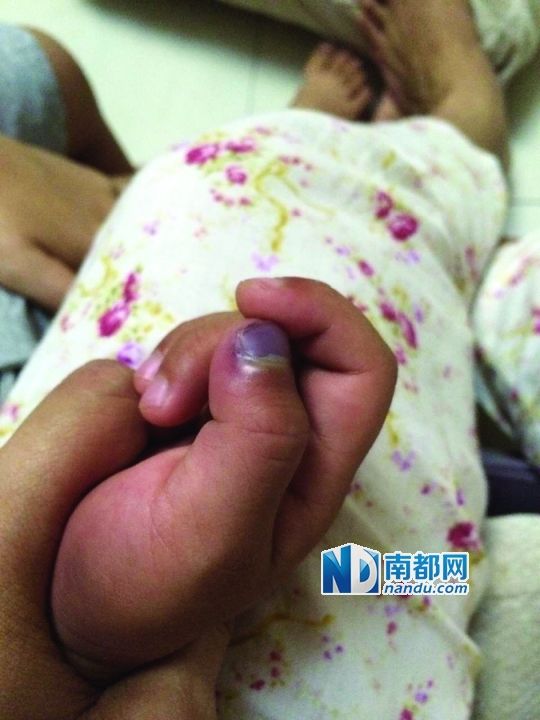 小逸手指被夾傷。