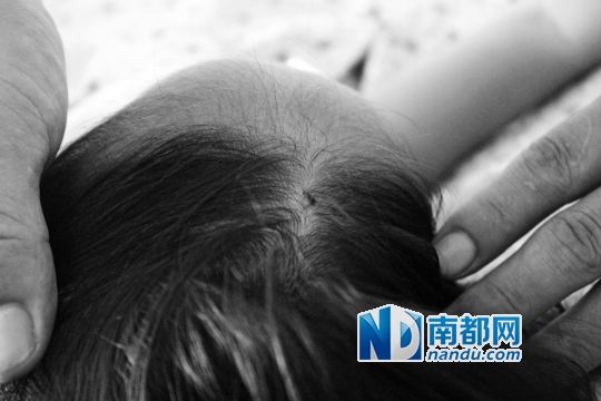 女童頭上被扎的針孔（圓圈處）。賈先生說，被扎不到三秒鐘，女兒就昏了。