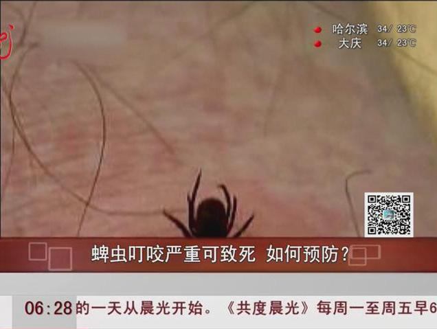 蜱蟲叮咬嚴重可致死如何預防？